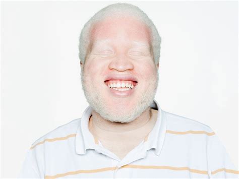 Is there a difference between the skin of an albino and a redhead ...