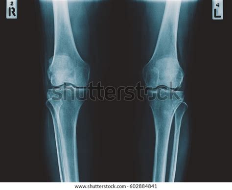 Film Xray Both Knee Joints Ap Foto de stock 602884841 | Shutterstock