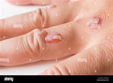 Man's hand covered with blisters caused by cryosurgery - wart removal ...