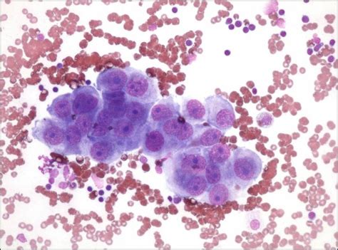 Pleural fluid cytology: differentiated mesothelioma; hemorrhagic ...