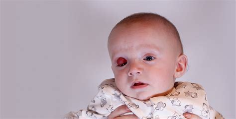 What You Should Know if Your Child Is Born with a Facial Deformity ...