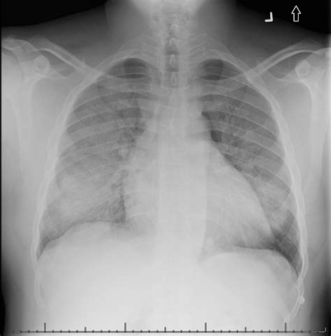 Diffuse Alveolar Hemorrhage in the ED: Pearls & Pitfalls - emdocs