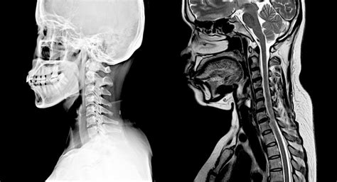 Prep for Cervical Spine MRI | American Health Imaging