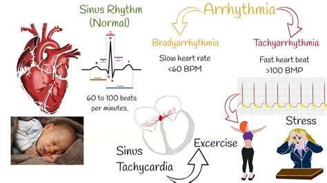 Tachycardia - Most Common causes and Symptoms - YouTube