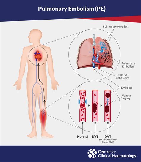 Pulmonary Embolism | CFCH | Centre for Clinical Haematology