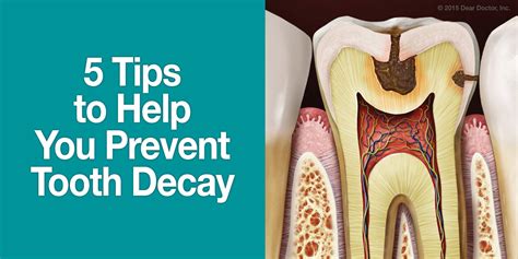 5 Tips to Help You Prevent Tooth Decay | DentalPlans Blog