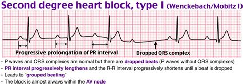 Rosh Review | Heart blocks, Ecg interpretation, Medicine notes