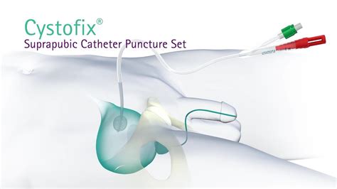 Suprapubic Catheter Set