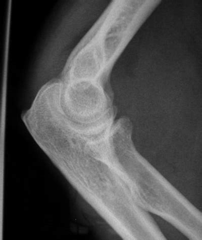 Elbow X Ray Fracture