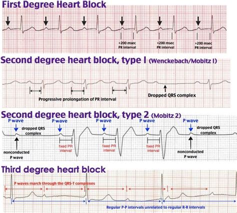 Pinterest | Heart blocks, Cardiology, Cardiac nursing