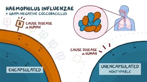 Haemophilus influenzae: Video, Anatomy & Definition | Osmosis