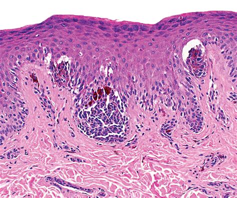 Junctional Melanocytic Nevus