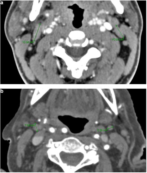 Jugulodigastric lymph node size by age on CT in an adult cancer-free ...