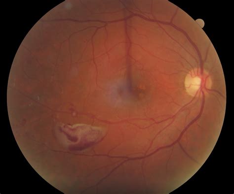 Diabetic Retinopathy - The Retina Centers of Washington