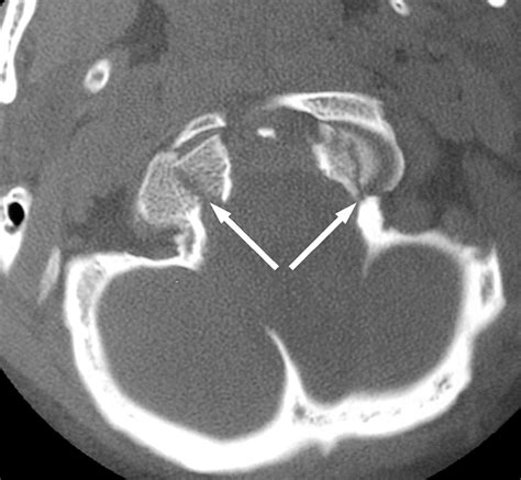 Radiologic and Clinical Spectrum of Occipital Condyle Fractures ...