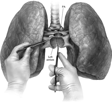 Bilateral Lung Transplantation - Operative Techniques in Thoracic and ...