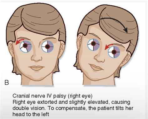 What Is Fourth Nerve Palsy With Pictures | The Best Porn Website