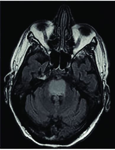 MRI imaging demonstrating central pontine myelinolysis A The axial ...