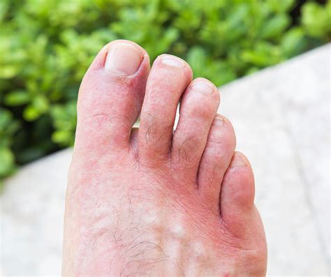 Why Are My Feet Itchy? Our Top Tips For Itchy Toes And Feet – My FootDr