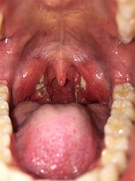 Infectious Mononucleosis: Pharyngitis and Morbilliform Rash - JETem