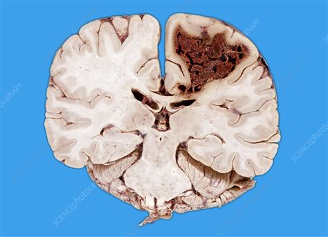 Cerebral Infarction from Embolus - Stock Image - C027/1076 - Science ...