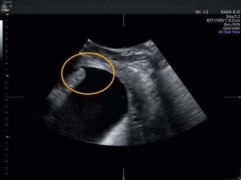 Diagnosing Urethral Diverticula with Ultrasound | Empowered Women's Health