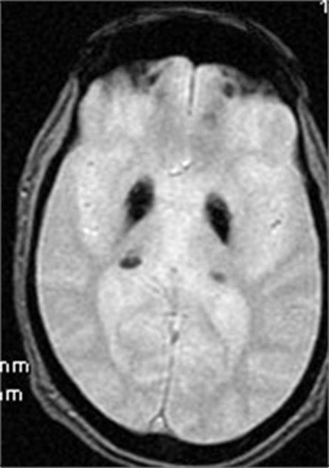 Basal Ganglia Calcification-Differential Diagnosis - Sumer's Radiology Blog