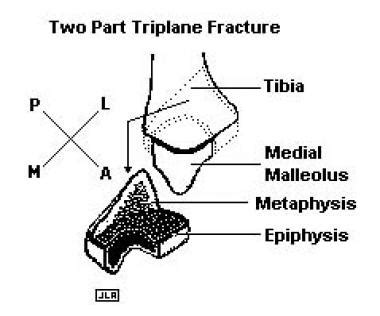 Triplane Fracture: Background, Anatomy, Pathophysiology_About Surgery