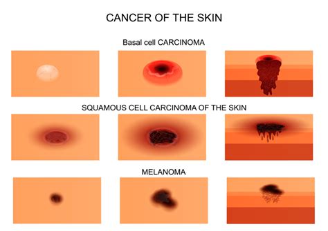 3 Skin Cancer Types and Their Warning Signs - University Health News