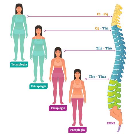 spinal-cord-injury-level-of-neurological-injury-propel-physiotherapy ...