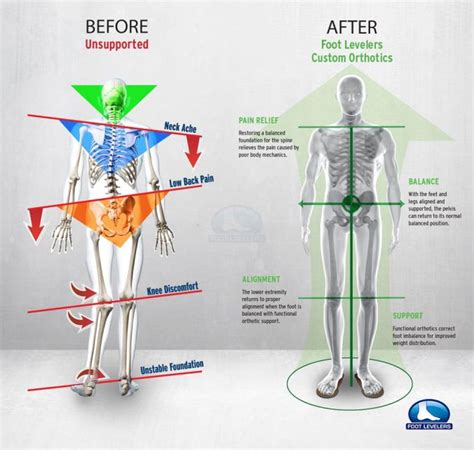 Addressing Functional Scoliosis Through Foot Stabilization - Foot Levelers