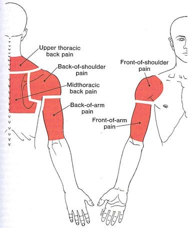 Upper Back, Shoulder, and Arm | The Trigger Point & Referred Pain Guide