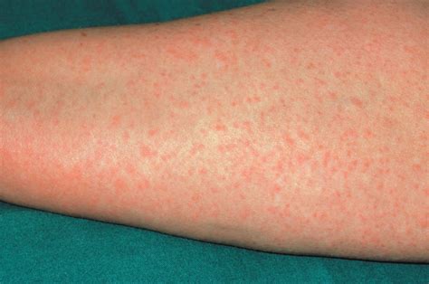 Penicillin allergy: identification and management - The Pharmaceutical ...