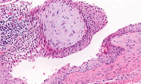 Residual Cyst Histology