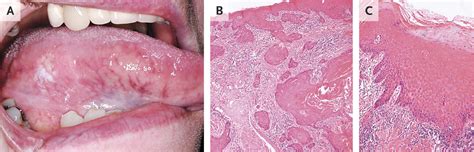 Squamous Cell Carcinoma Tongue