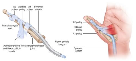 Understanding Trigger Thumb And Ways You Can Help It