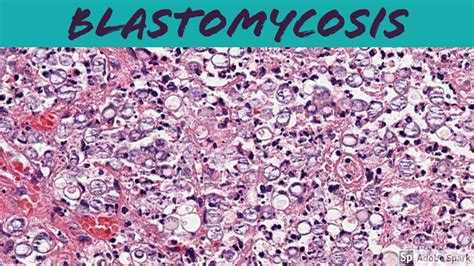 Blastomycosis Histology