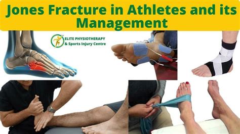 Jones Fracture in Athletes and Its Management