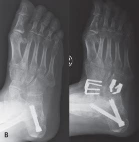 Triple Arthrodesis | Musculoskeletal Key