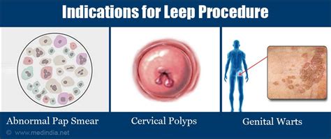 LEEP (Loop Electrosurgical Excision Procedure) - Indications ...