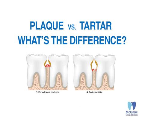 Plaque vs. Tartar: What’s The Difference? - McOmie Family Dentistry