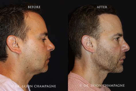 Custom Jaw and Chin Implants | Beverly Hills Plastic Surgeon - Dr ...