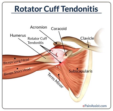 Rotator Cuff Tendonitis - Motus Physical Therapy