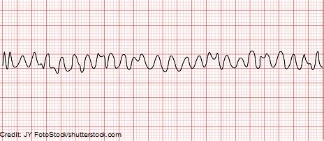 Ventricular Fibrillation (V-fib) ECG/EKG Nursing Review