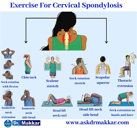 Neck Exercises For Cervical Spondylosis, 54% OFF | rbk.bm