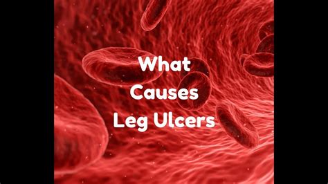 what causes leg ulcers - YouTube