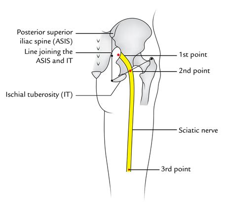 Sciatic Nerve Chart