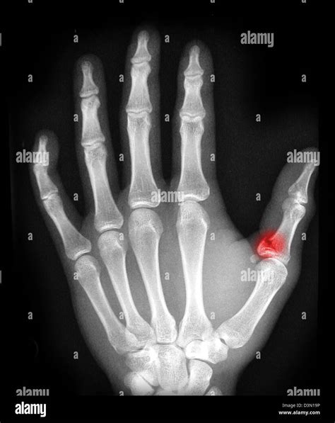 x-ray showing an avulsion fracture of the proximal phalanx of the thumb ...