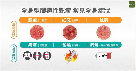 The Truth About Generalized Pustular Psoriasis: Symptoms, Diagnosis ...