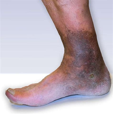 Venous Insufficiency: Causes, Symptoms, and Treatment